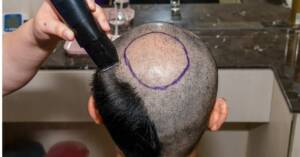 Şanlıurfa’da merdivenaltı saç ekim merkezleri