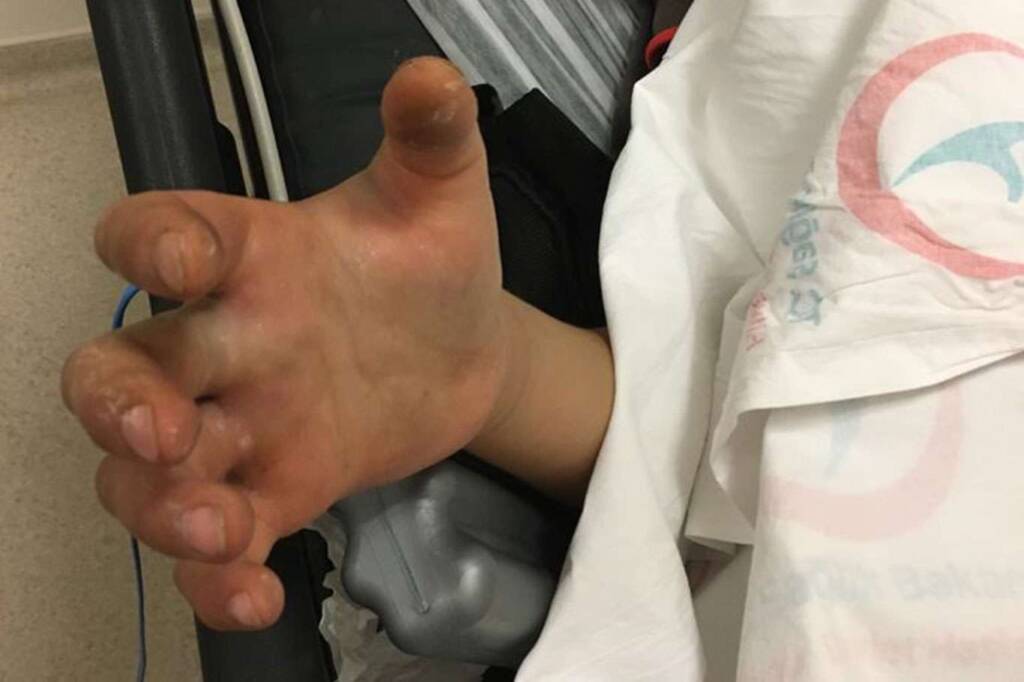 Şanlıurfa’da Engerek yılanının ısırdığı çocuğun hayati tehlikesi sürüyor