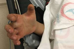 Şanlıurfa’da Engerek yılanının ısırdığı çocuğun hayati tehlikesi sürüyor