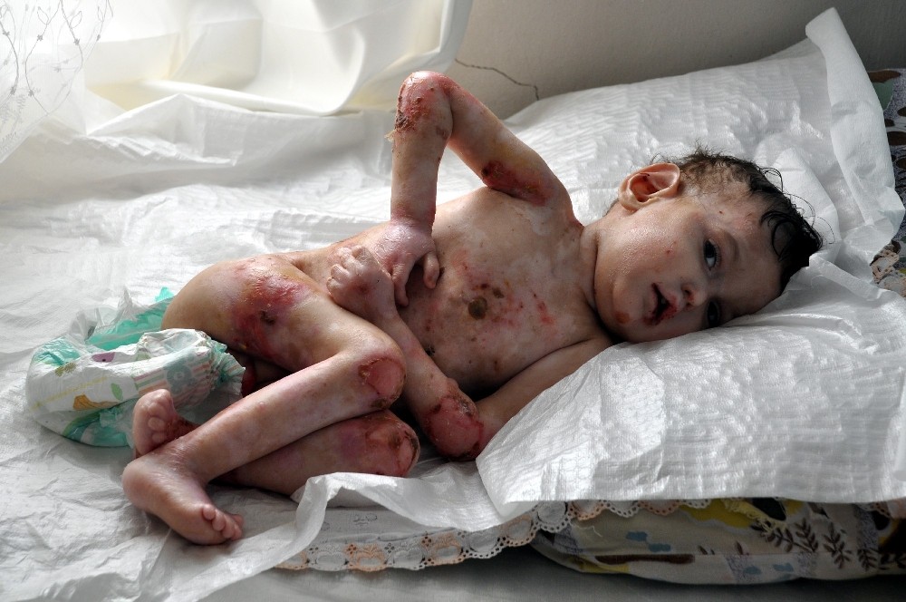 Şanlıurfa’da Vücudu yara içerisinde olan 3 yaşındaki çocuk yardım eli bekliyor