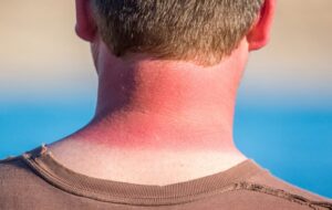 Güneş yanığının etkilerini azaltacak 12 uyarı