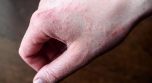 El Dezenfektanları Egzamaya Davetiye Çıkarıyor