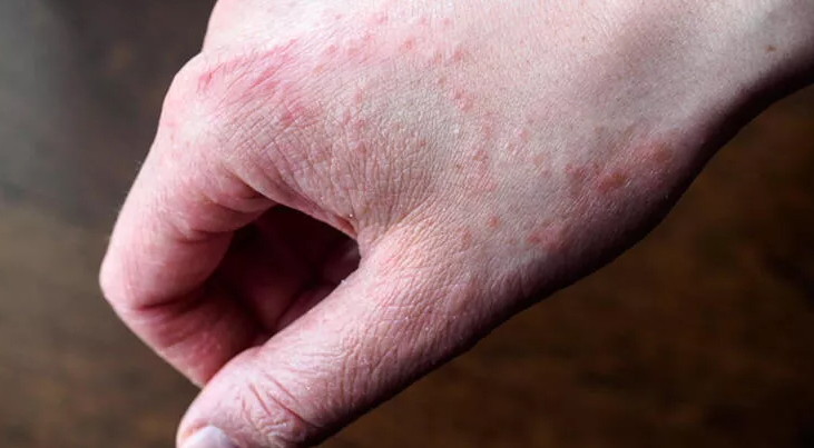 El Dezenfektanları Egzamaya Davetiye Çıkarıyor