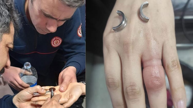 Şanlıurfa’da Kadının parmağına sıkışan yüzük kesilerek çıkartıldı