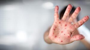 Sağlık Bakanlığından  dünyayı sarsan ‘maymun çiçeği’ hastalığı açıklaması