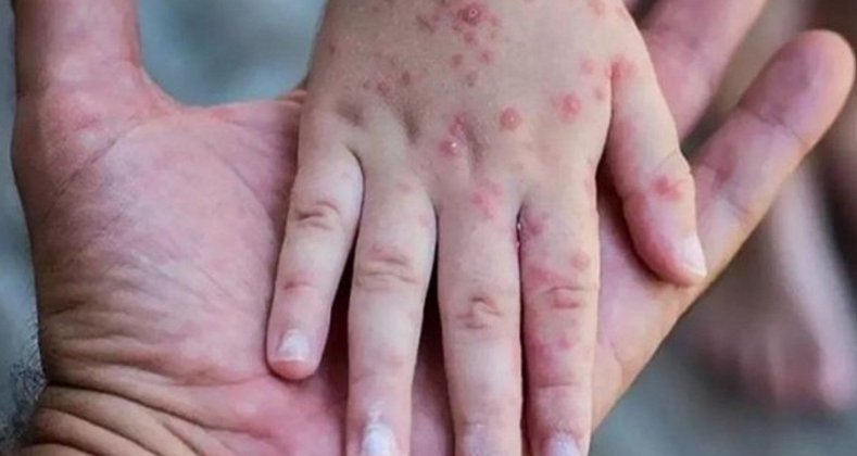 Bakan Koca’dan maymun çiçeği virüsü açıklaması