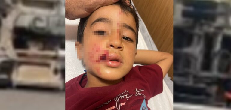 Şanlıurfa’da 8 yaşındaki çocuk sokak köpeğinin saldırısına uğradı