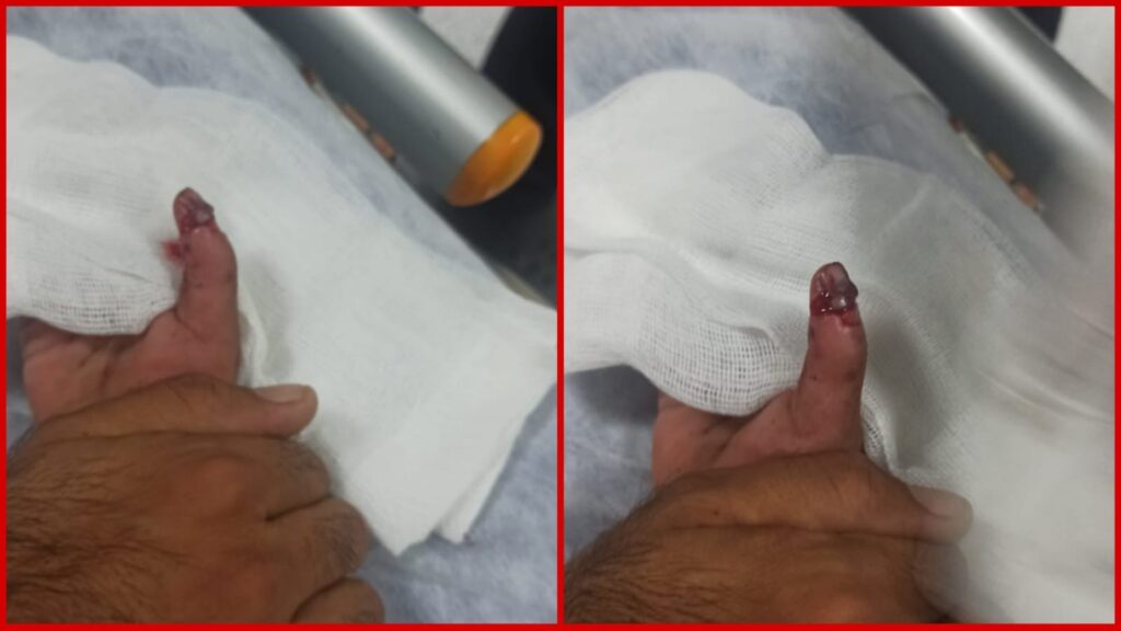 Şanlıurfa’da 4 yaşındaki çocuğun parmağı kurtarıldı