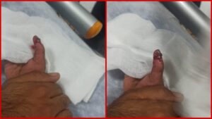 Şanlıurfa’da 4 yaşındaki çocuğun parmağı kurtarıldı