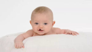 Dudak-damak yarığı Güneydoğu Anadolu’da yaygın