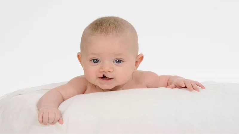 Dudak-damak yarığı Güneydoğu Anadolu’da yaygın