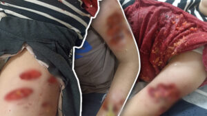 Karaköprü’de 12 yaşındaki kız başıboş köpeklerin saldırısına uğradı