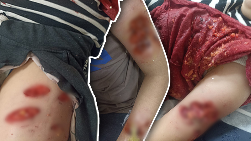 Karaköprü’de 12 yaşındaki kız başıboş köpeklerin saldırısına uğradı